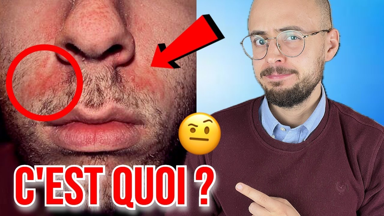 Pellicules sur le visage : la dermite seborrhéique