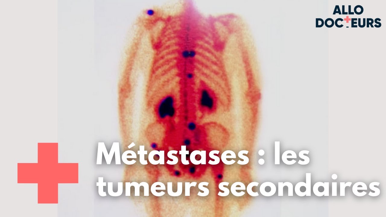 Métastases, quelle prise en charge ? - Allo Docteurs